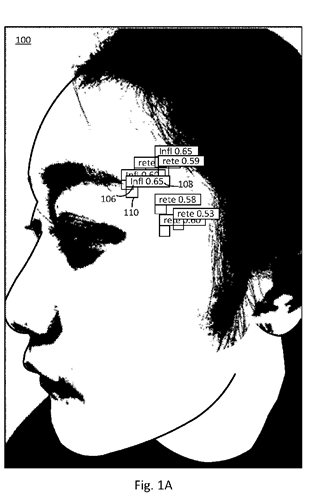 Figure 1A of L'Oréal acne patent